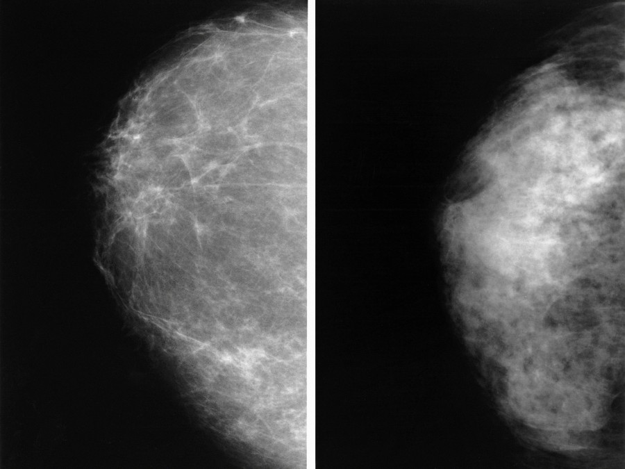 Just What's Inside Those Breasts? : NPR